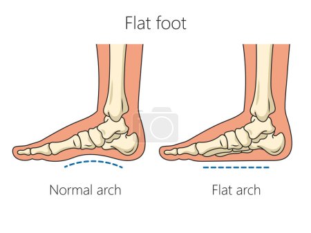 Illustration for Flat feet bones schematic vector illustration. Medical science educational illustration - Royalty Free Image