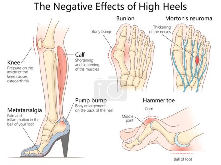 Illustration for Health issues caused by high heels, including bunions, hammer toe, knee pain, and calf muscle strain diagram hand drawn schematic vector illustration. Medical science educational illustration - Royalty Free Image