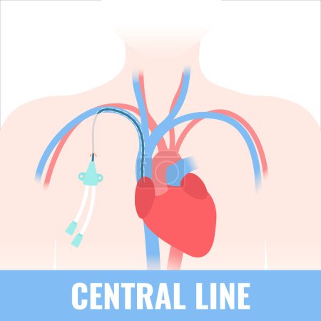 Vector of Tunneled central venous - ID:2-634057432 - Royalty Free Image ...