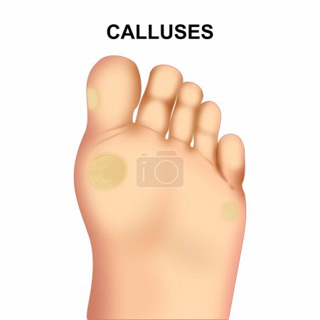 Illustration for Foot Calluses Medical Illustration - Royalty Free Image