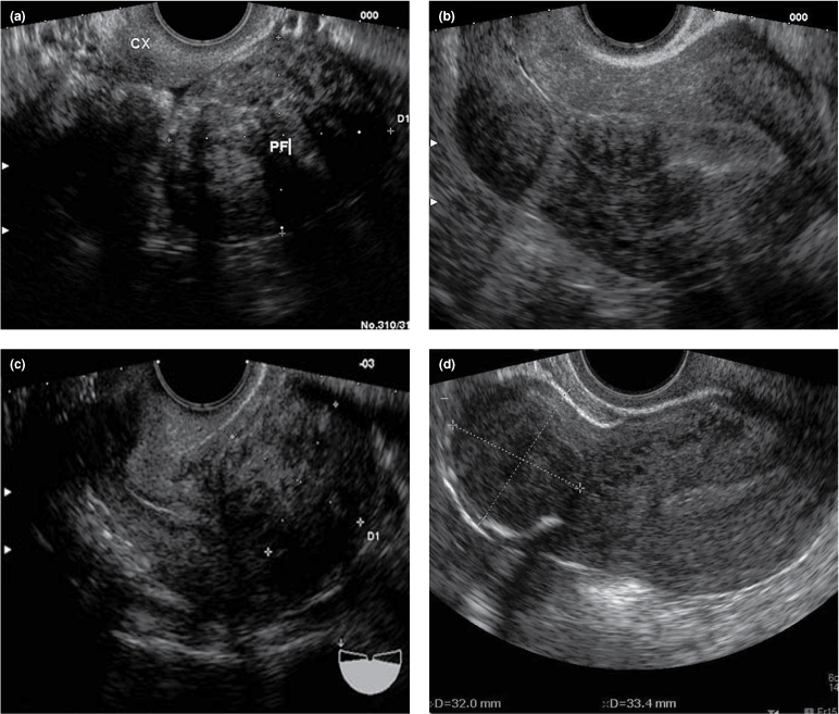 Uterus Fibroids Ultrasound