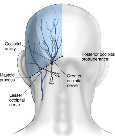 Interventionalpain management I: epidural, ganglion, and nerve blocks ...