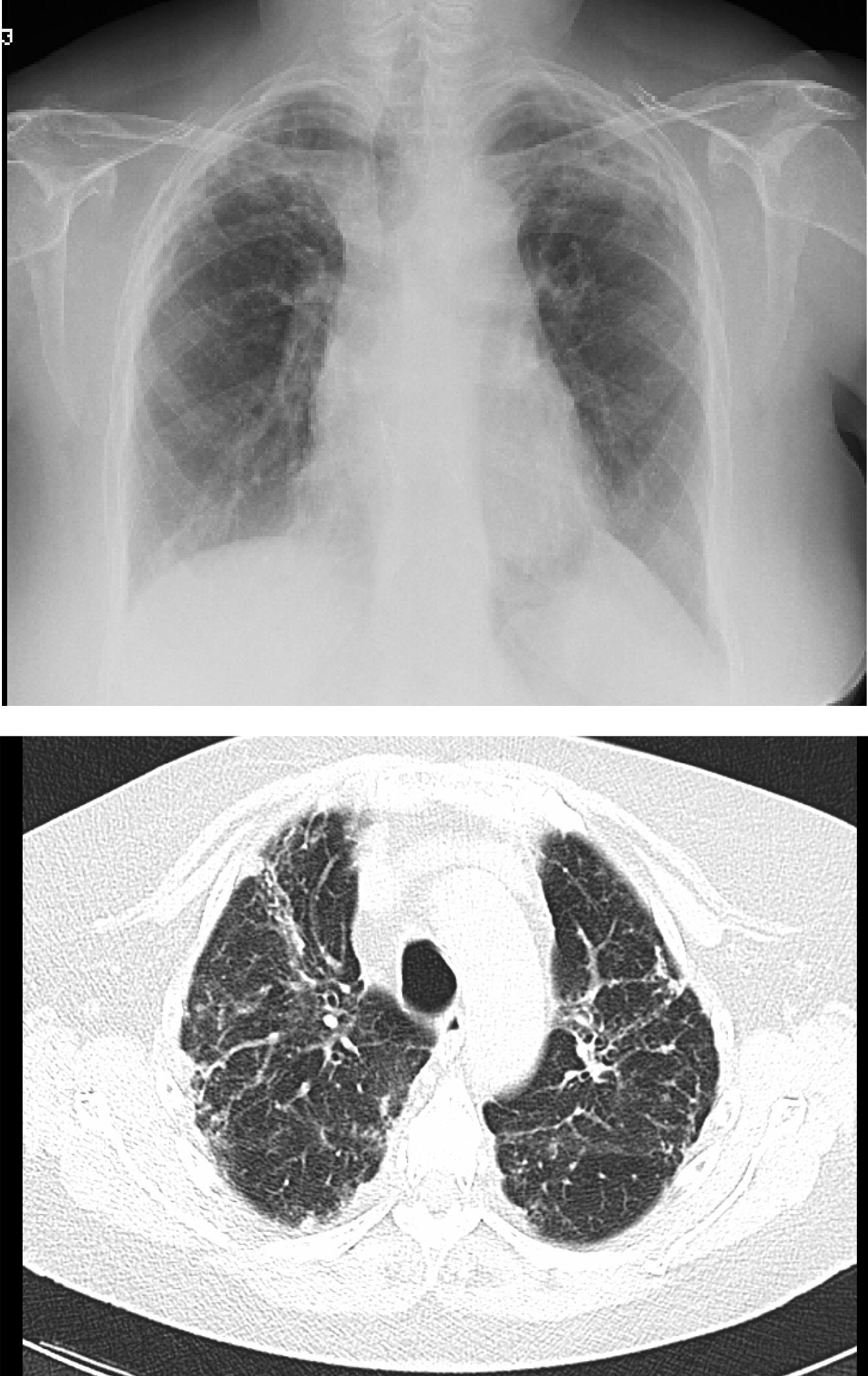 Seguimiento a largo plazo del paciente trasplantado pulmonar | Archivos ...