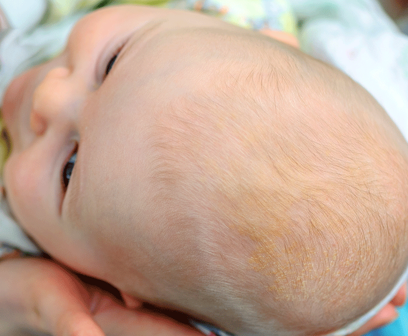 cradle cap in babies