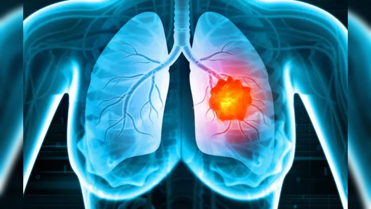 Lung Cancer: Tell-tale Symptoms In Those Who Never Smoked | Health News ...