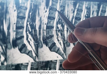 Doctor Examines Mri Of Lumbar Spine With Pinched Discs Of Spine And Nerves, Points At Problem Areas 