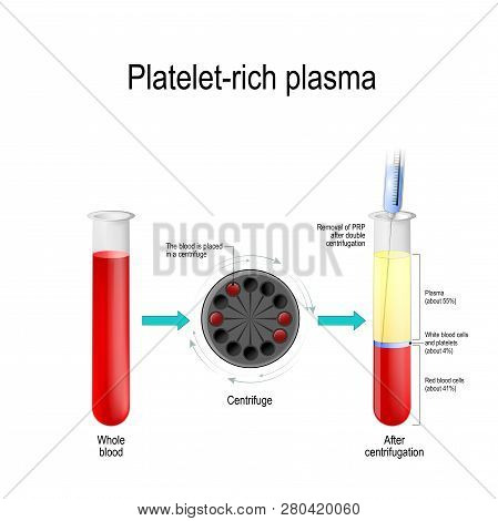 Platelet-rich Plasma. Autologous Conditioned Plasma, Is A Concentrate Of Platelet-rich Plasma Derive