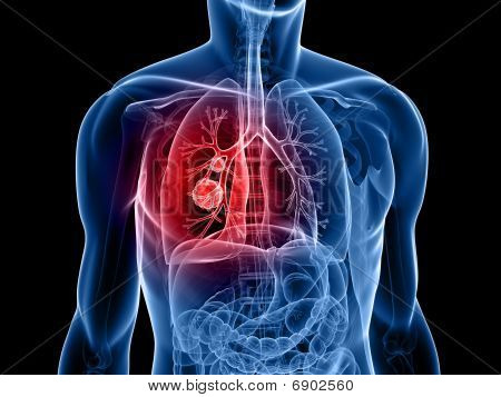 lung tumor