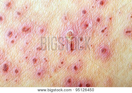 Herpes Zoster (shingles) - After Treatment