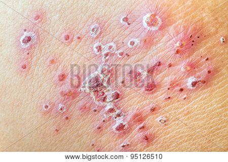 Herpes Zoster (shingles) - After Treatment