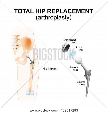 Total hip replacement or arthroplasty and hip Implant