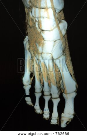 Scan image of foot