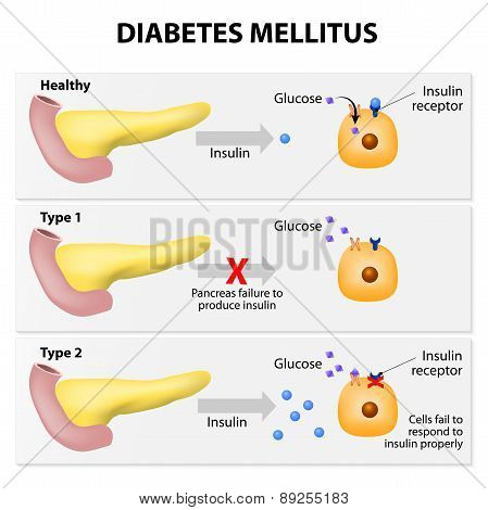 Diabetes Mellitus