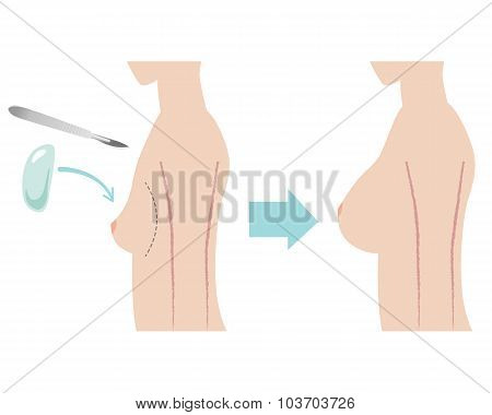 Silicone Breast Implant With Sideview Of Body