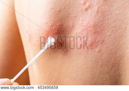 Cotton Swab Treatment Of Skin Rash. Shingles, Varicella-zoster Virus. Skin Rash And Blisters On Body