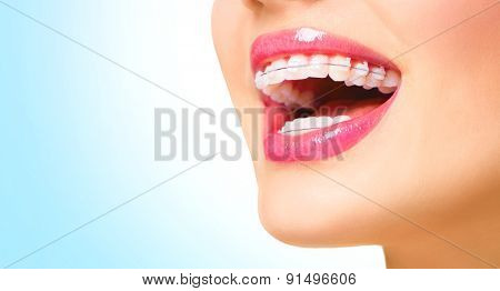 Braces. Beautiful Woman healthy smile close up. Closeup Ceramic Braces on Teeth. Beautiful Female Smile with Braces. Orthodontic Treatment. Dental care Concept. Beautiful Lips and Teeth