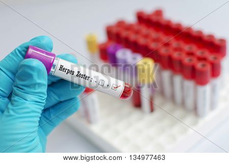 Blood sample positive with herpes zoster test