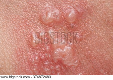 Shingles, Zoster Or Herpes Zoster Symptoms On Arm