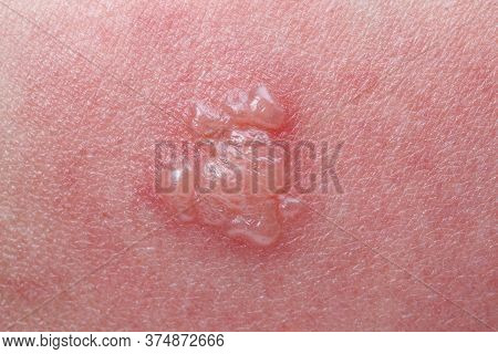 Shingles, Zoster Or Herpes Zoster Symptoms On Arm