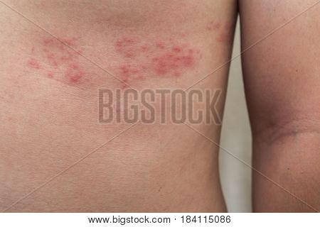 Detail of body skin with Herpes Zoster (Shingles)