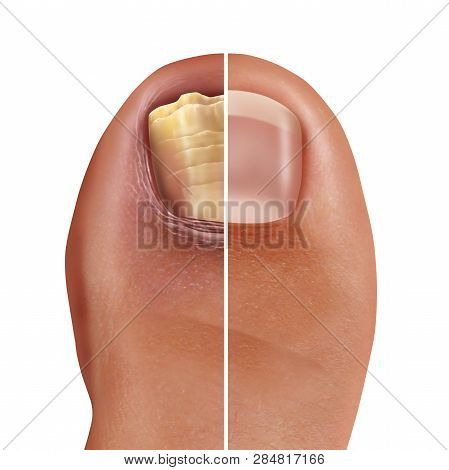 Fungal Nail Infection And Onychomycosisor Tinea Unguium As An Infected Foot Toenail Or Toe Nail With