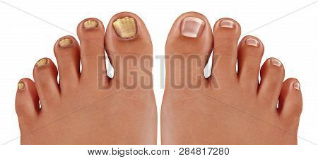 Onychomycosis And Fungal Nail Infection Or Tinea Unguium As An Infected Foot Toenail Or Toe Nail Wit