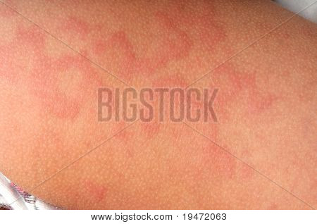 Close up image of a little boy's body suffering severe urticaria, nettle rash.