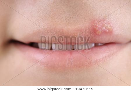 Close up of lips affected by herpes.