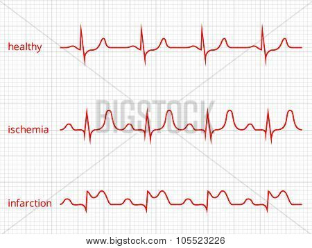 Heart cardiogram vector charts set. Healthy heart rhythm, ischemia, infarction