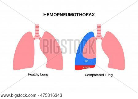 Hemopneumothorax Vector & Photo (Free Trial) | Bigstock