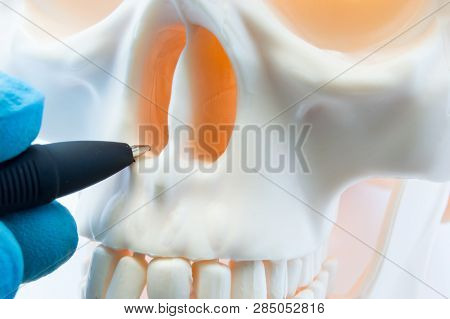 Doctor Showing Patient Bone Anatomy Of Skeleton Of Nose And Nasal Cavity On Skull. Preparing For Rhi