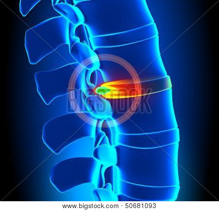 Herniated Disc Degeneration - Spine problem