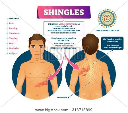 Shingles Vector Illustration. Labeled Medical Skin Virus Explanation Scheme. Varicella Zoster Illnes