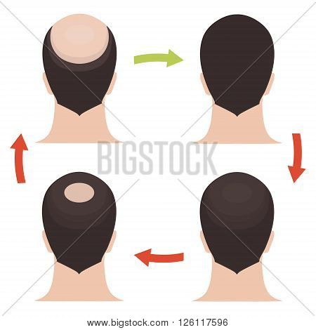 Hair loss stages set. Rear view of a man losing hair before and after hair treatment and hair transplantation. Implantation of hair. Male hair loss pattern. Alopecia. Hair growth. Vector illustration.