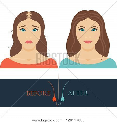 A woman losing hair before and after hair treatment and hair transplantation. Female hair loss set. Hair care concept. Hair bulb logo. Hair loss clinic concept design. Isolated vector illustration.