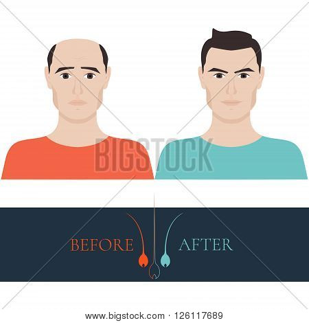 A man losing hair before and after hair treatment and hair transplantation. Male hair loss set. Hair care concept. Hair bulb logo. Hair loss clinic concept design. Isolated vector illustration.