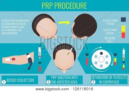 Platelet rich plasma injection. PRP therapy process. Male hair loss treatment infographics. Injection. Meso therapy. Hair growth stimulatio. Vector illustration.