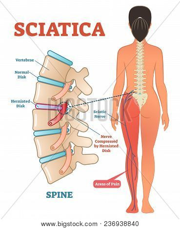 Sciatica Medical Health Care Vector Illustration Scheme With Lower Spine And Sciatic Nerve Pain In L