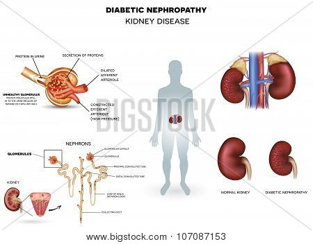 Diabetic Nephropathy, Kidney Disease