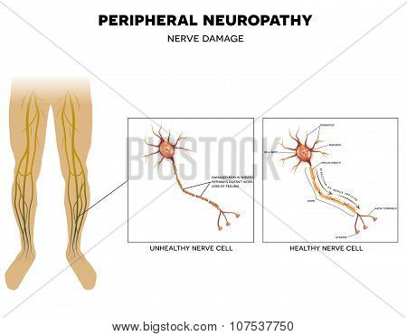 Neuropathy, Nerve Damage