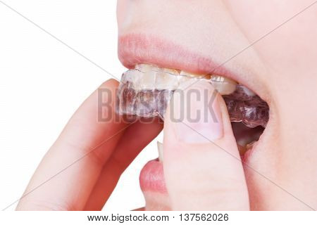 Woman Fixes Clear Aligner On Teeth Isolated