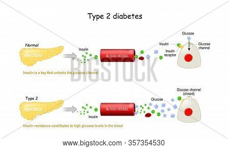 Types 2 Of Diabetes Mellitus. Comparison Of Cell Work In Diabetes And In A Healthy Body. Insulin Res