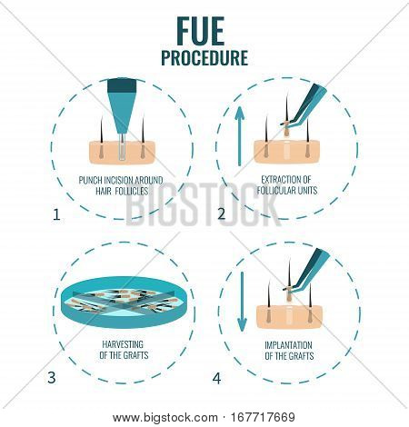 Follicular unit extraction procedure stages.  FUE hair loss treatment steps. Alopecia infographic medical design template for transplantation clinics and diagnostic centers. Vector illustration.