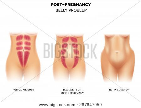 Female Body Before Pregnancy With Normal Muscles, Diastasis Recti During Pregnancy And Body Postpart