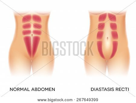 Diastasis Recti Also Known As Abdominal Separation, It Is Common Among Pregnant Women. There Is A Ga