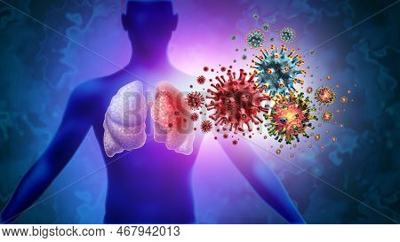 Triple Virus Lung Infection And Tripledemic Human Lung Infection And Respiratory Inflammation Diseas