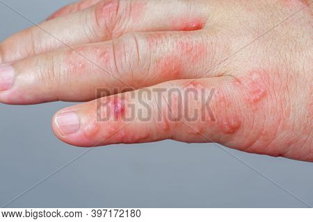 Shingles, Zoster Or Herpes Zoster Symptoms On Arm