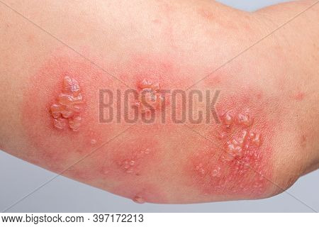 Shingles, Zoster Or Herpes Zoster Symptoms On Arm