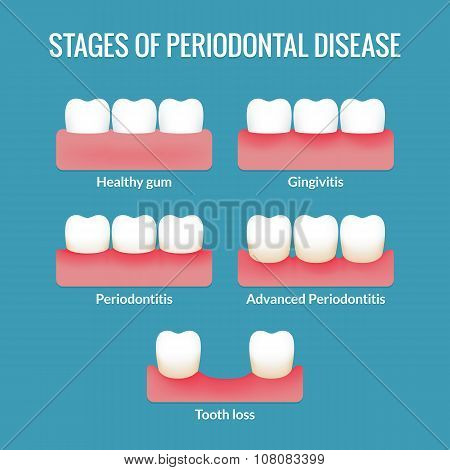 Periodontal Disease Chart