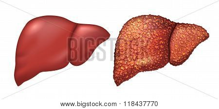 Liver of healthy person. Liver patients with hepatitis. Liver is sick person. Cirrhosis of liver. Re